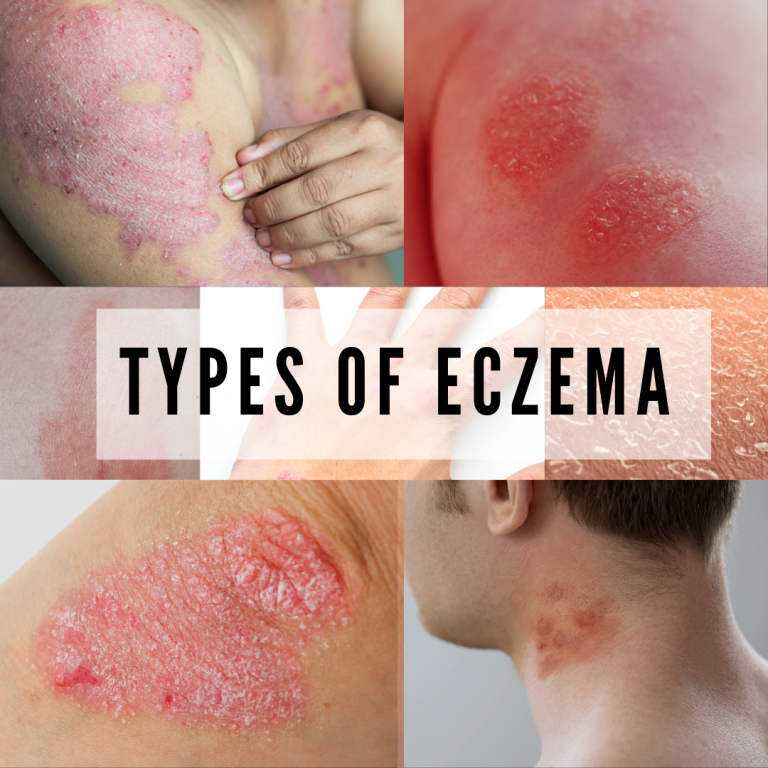 11 Different Types Of Eczema What Causes And Risk Factors Of Eczema Aputirich Centre 