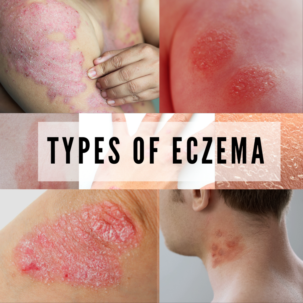 Cover Photo 7 Types Of Eczema 1080x 1024x1024 
